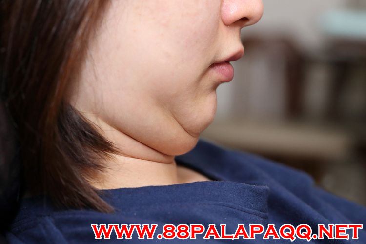 Penyebab Double Chin, Tidak Hanya Kelebihan Berat Badan